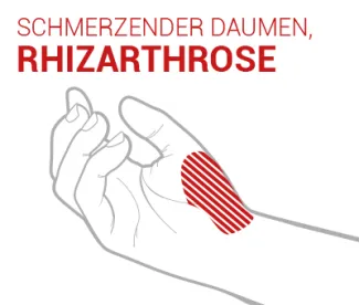 rhizarthrose