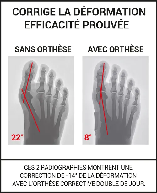 Orthèse corrective de l’hallux valgus double de jour