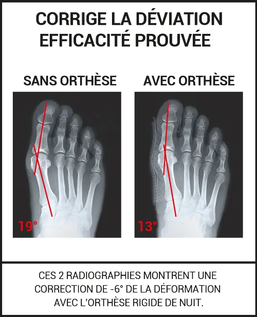 Orthèse Hallux Valgus Nuit