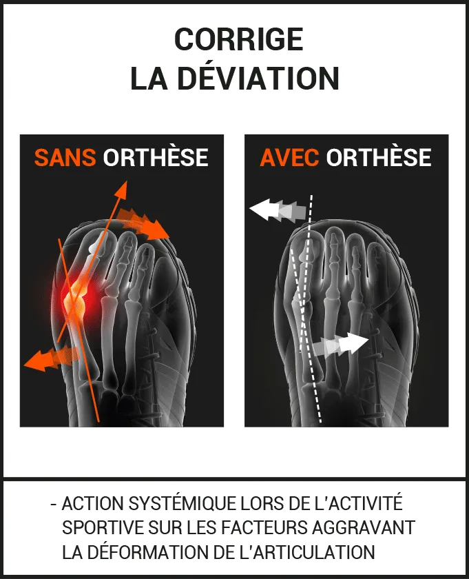 Orthèse Hallux Valgus SPORT