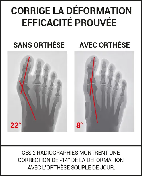 correction avec et sans orthèse hallux valgus EPITACT