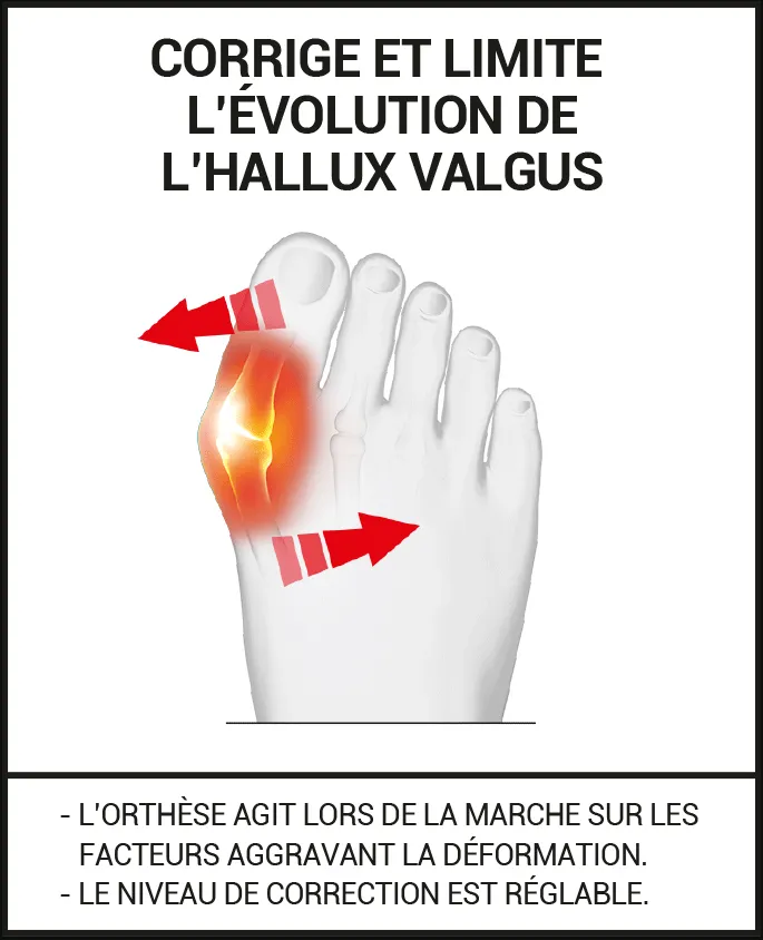 orthèse hallux valgus : redresseur d'orteil