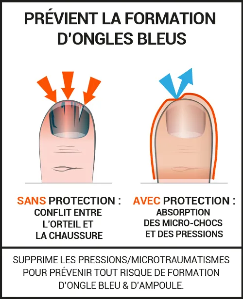 Protections ongles bleus durant la pratique du sport 