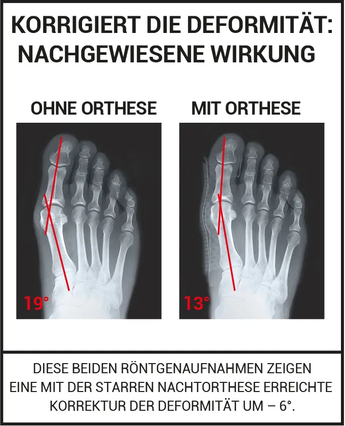 HALLUX VALGUS KORREKTURORTHESE BALLENZEH